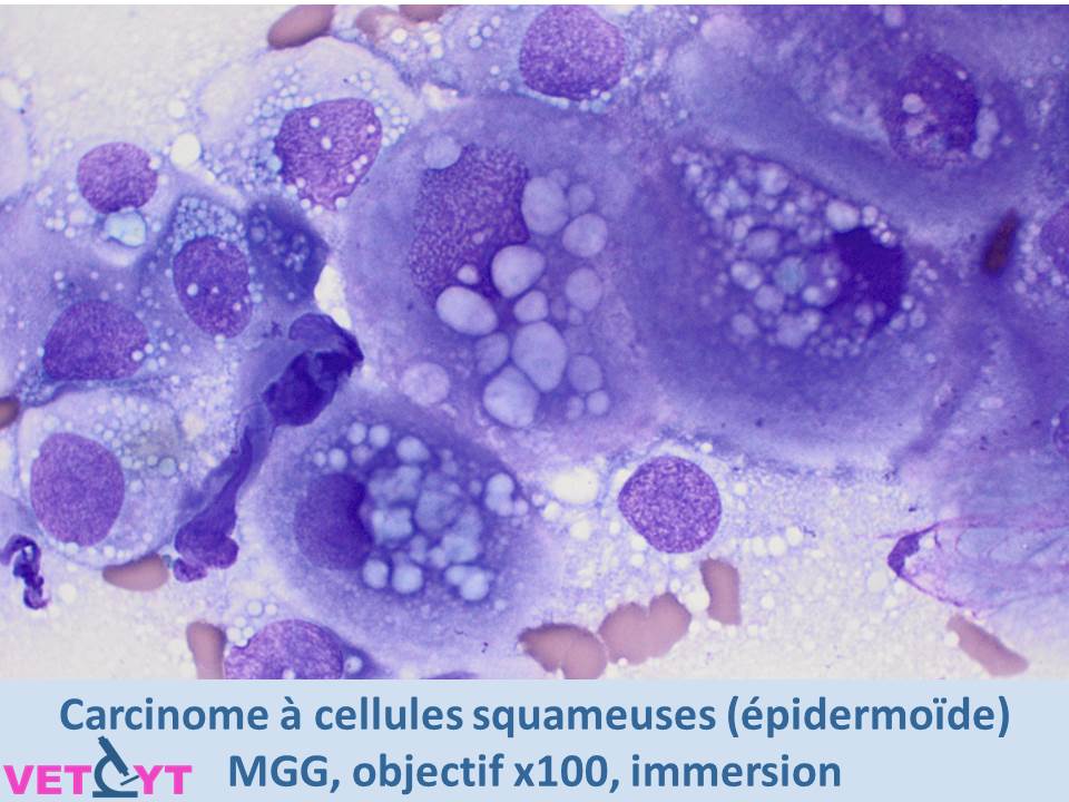 Cytologie-Carcinome-a-cellules-squameuses
