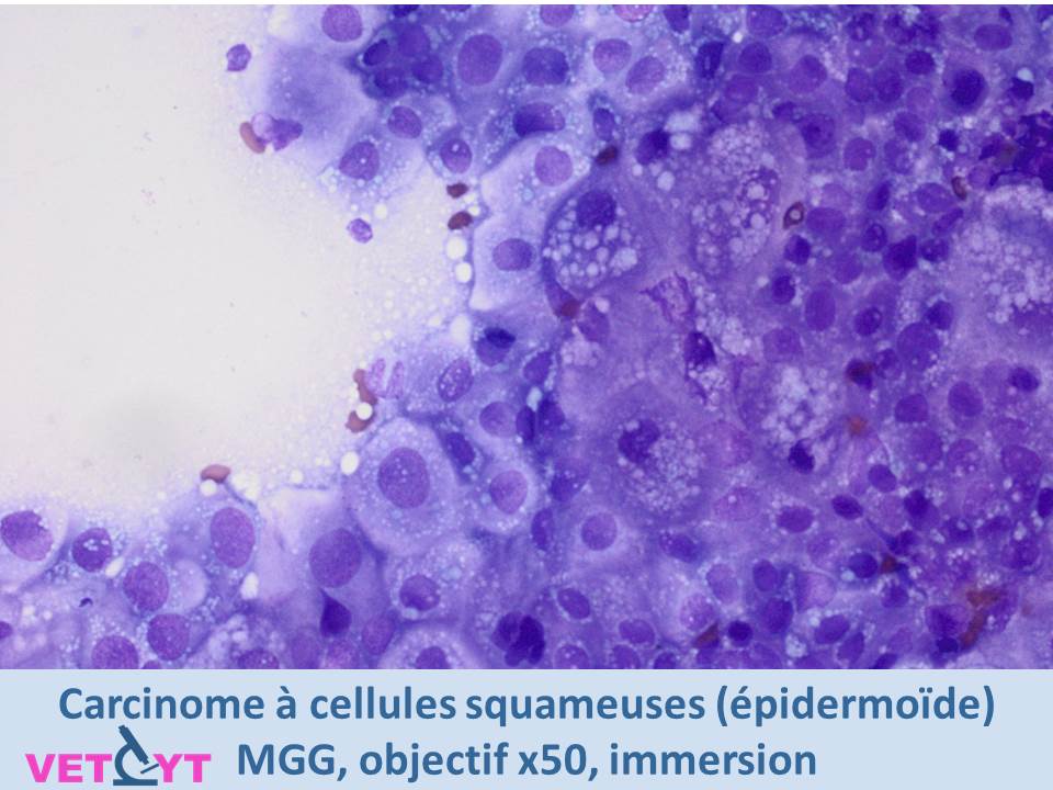 ytologie-carcinome-a-cellules-squameuses