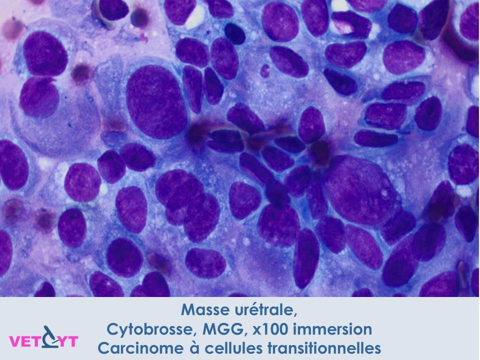 Cytologie-Carcinome-a-cellules-transitionnelles