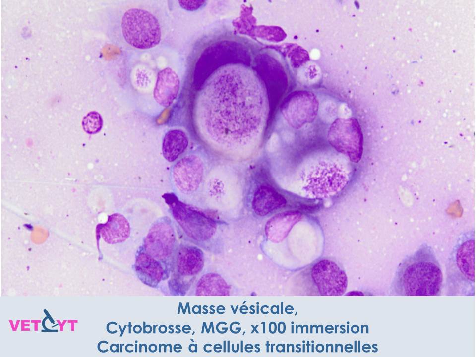 Cytologie-Carcinome-a-cellules-transitionnelles