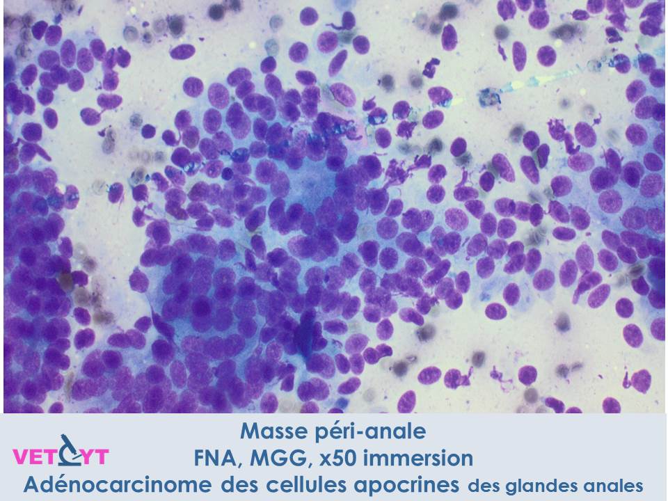 Adénocarcinome des cellules apocrines des glandes anales