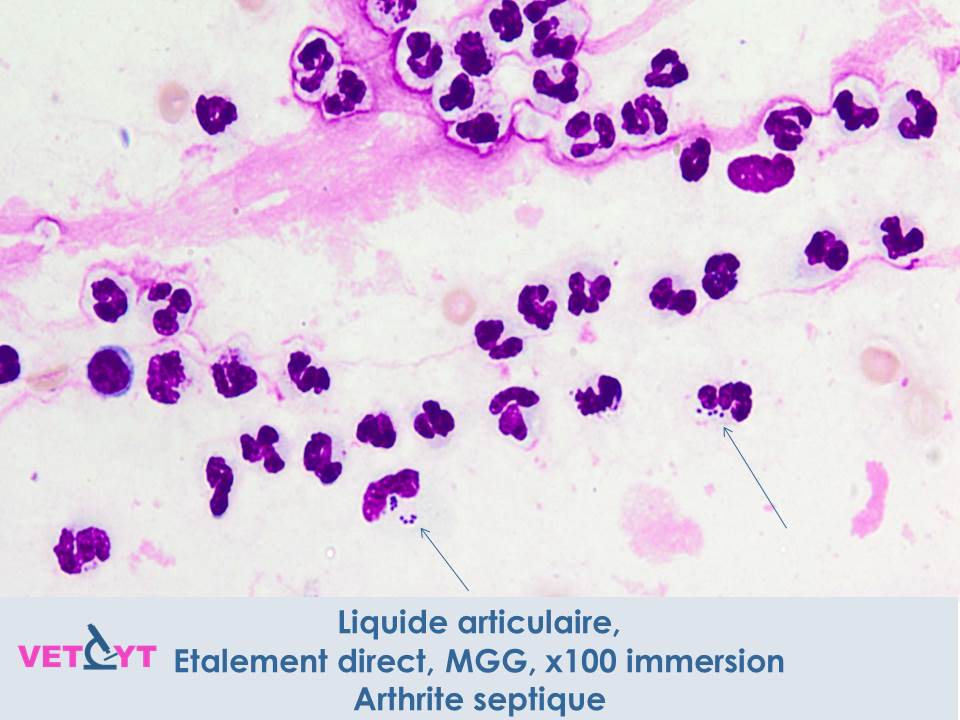 cytologie-arthrite-septique