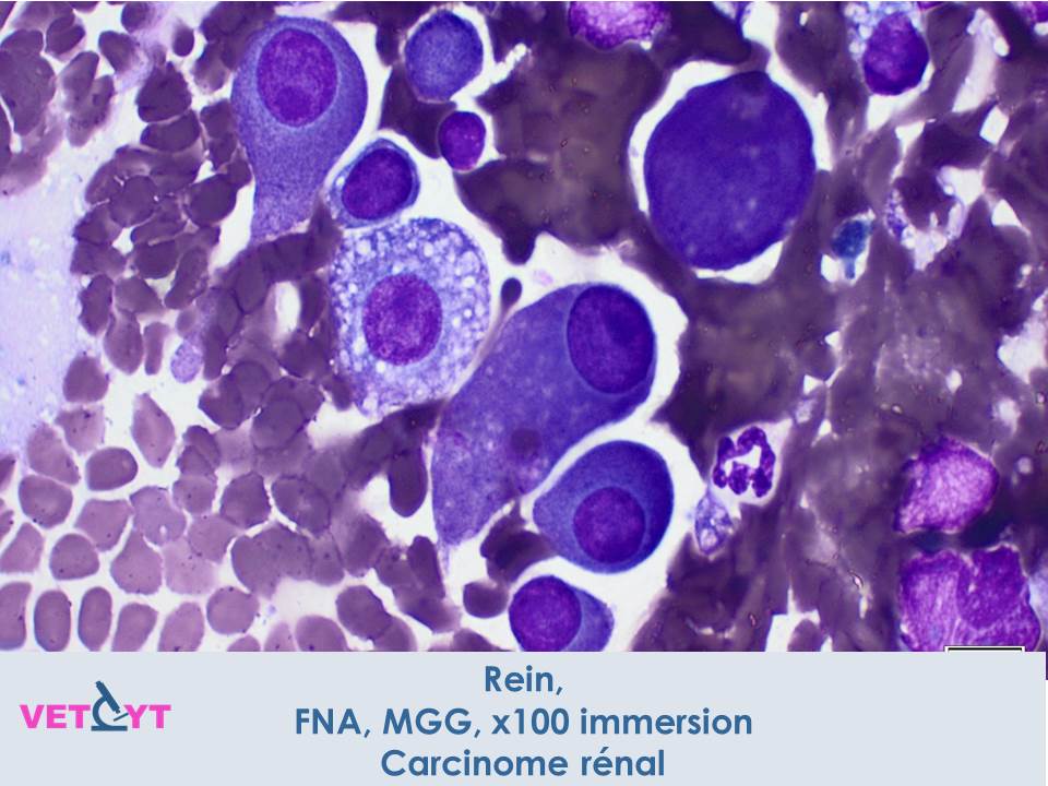 Carcinome rénal