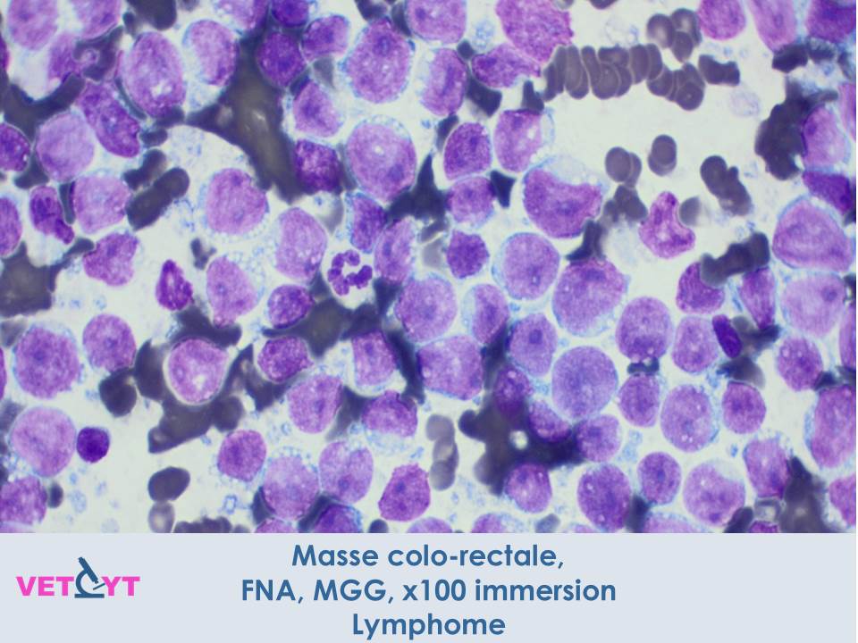 cytologie-lymphome-colo-rectal