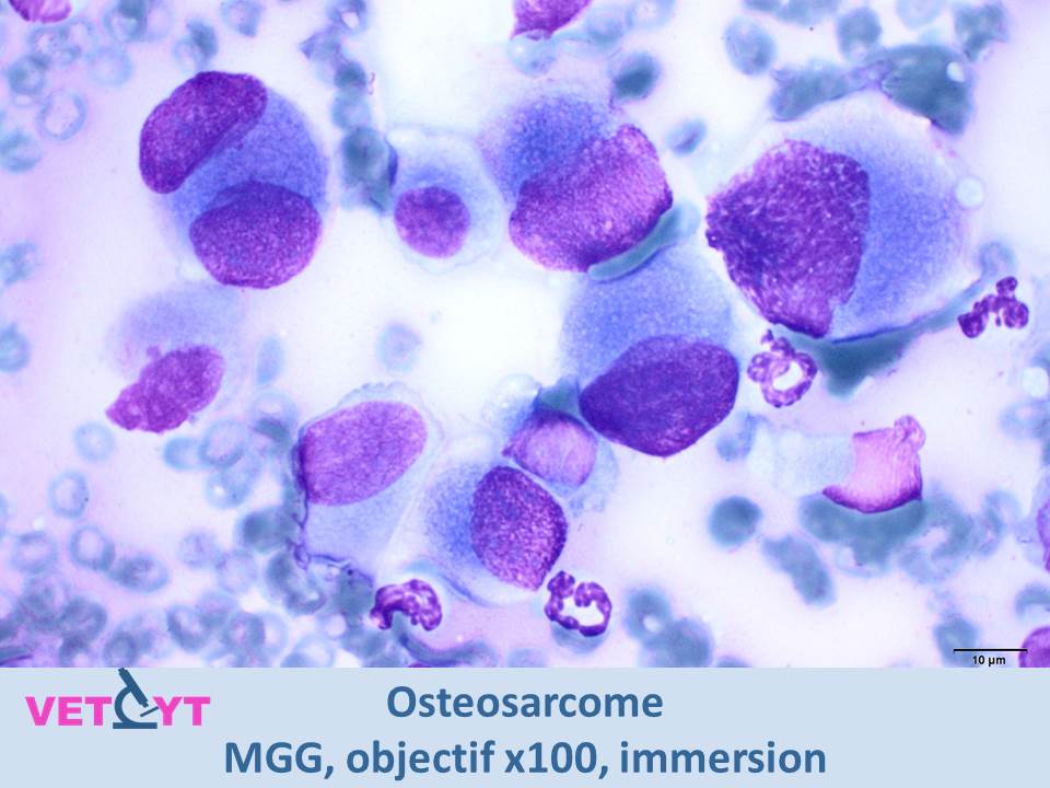 cytologie-osteosarcome