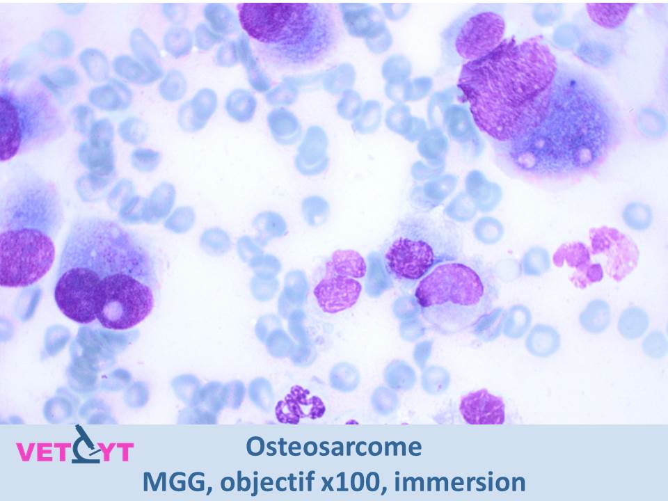 cytologie-osteosarcome