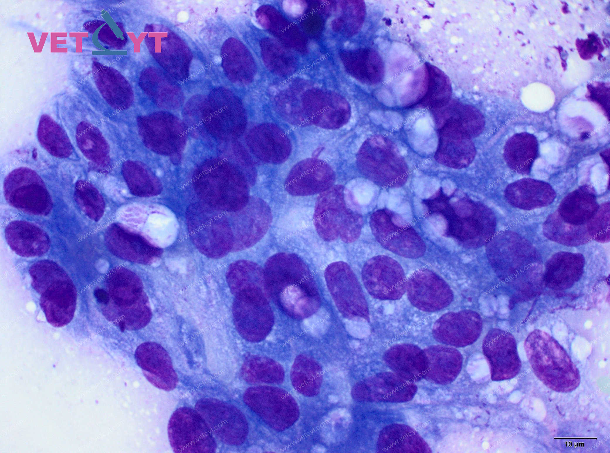 Adénocarcinome des glandes sébacées