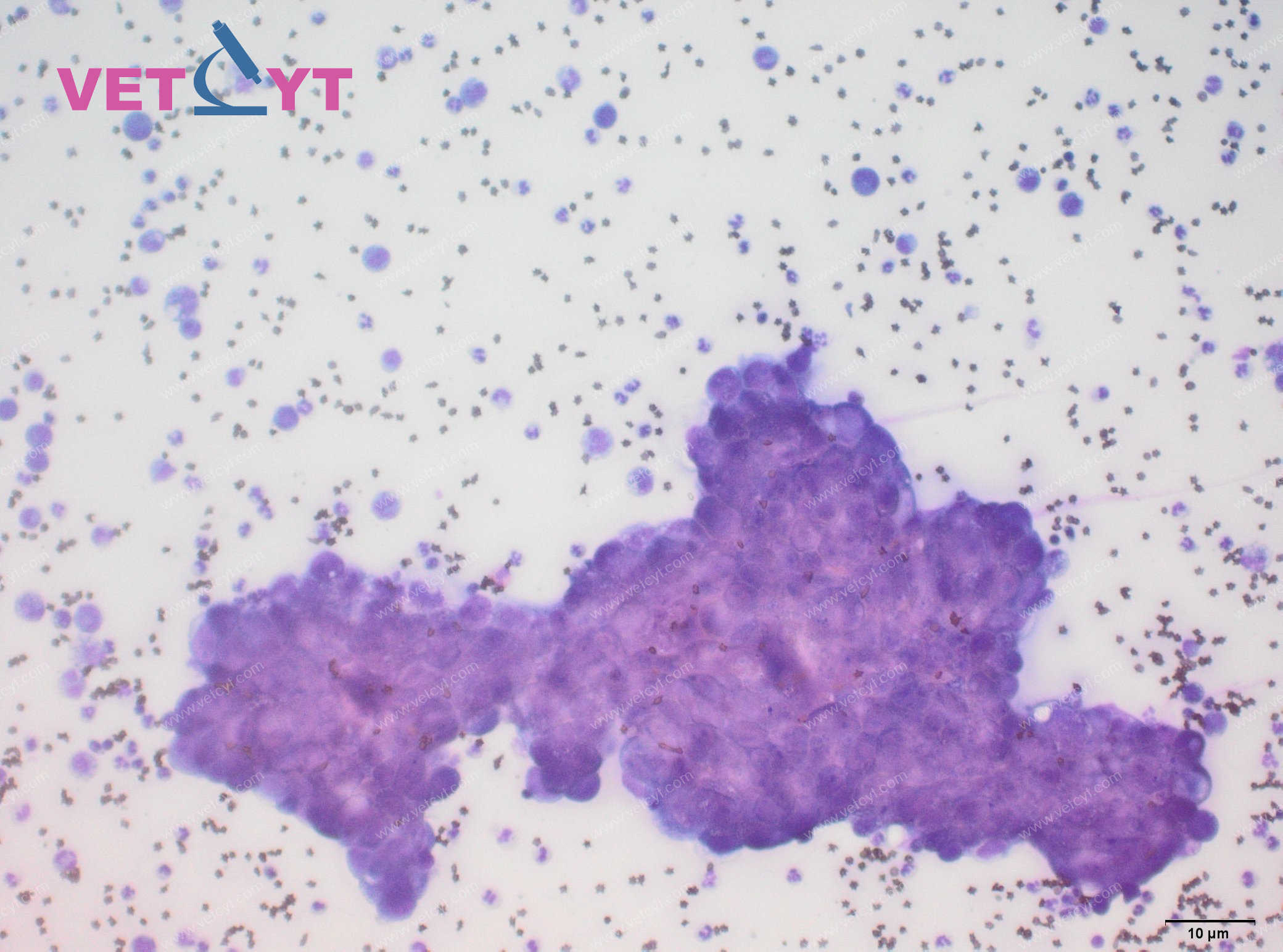Épanchement carcinomateux