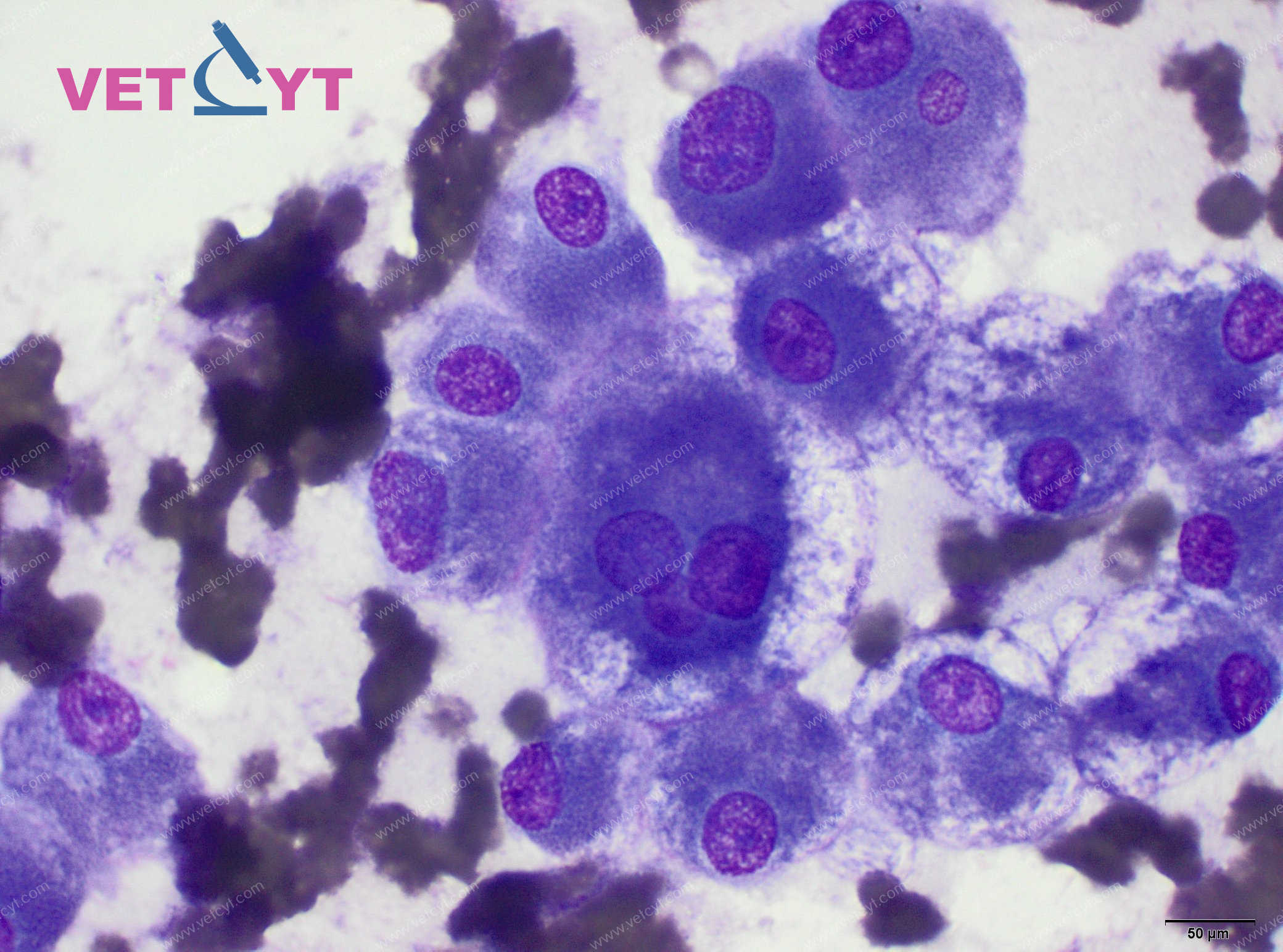 Hépatocarcinome