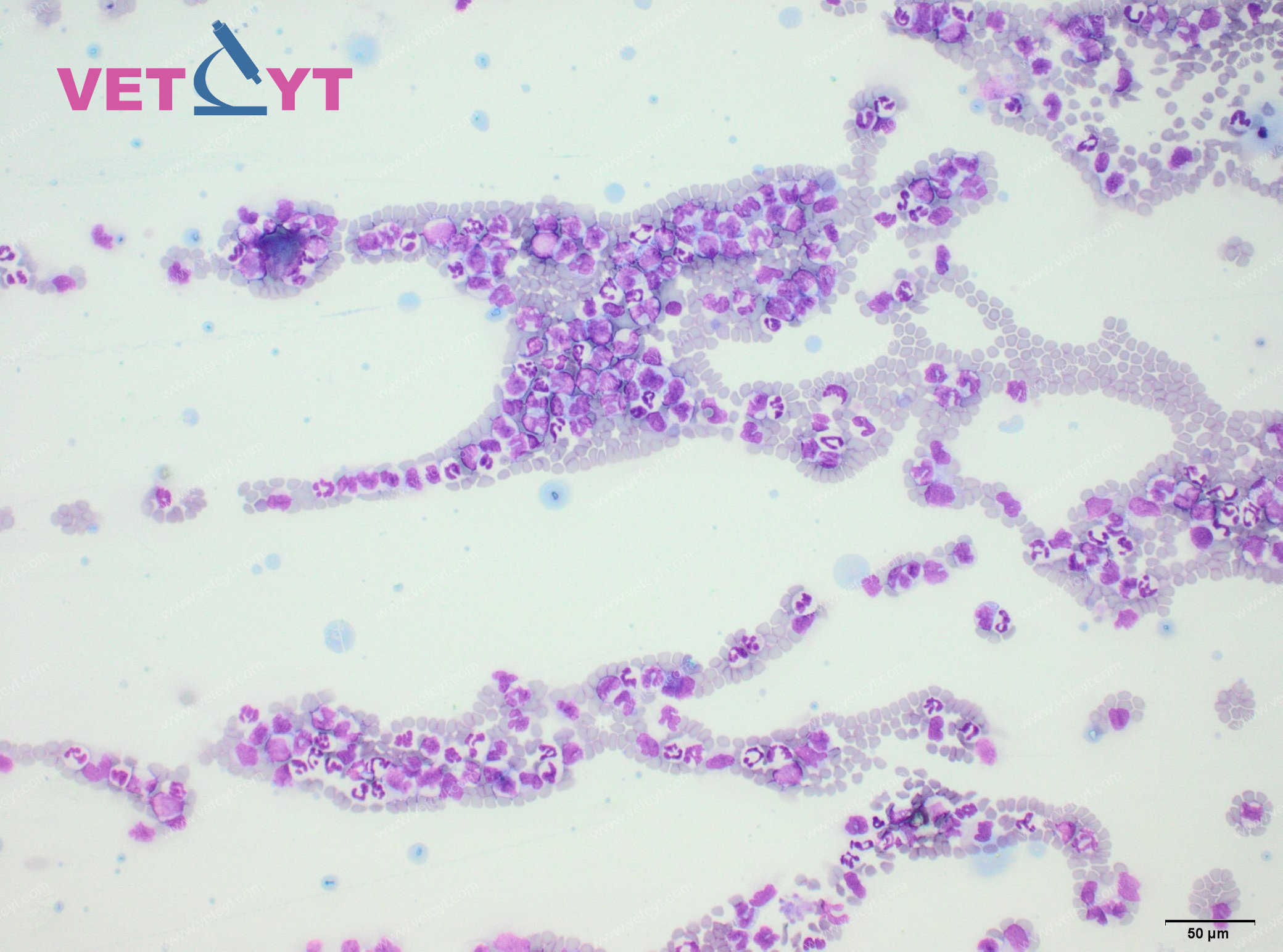 Leucémie myélomonocytaire (AML-M4)