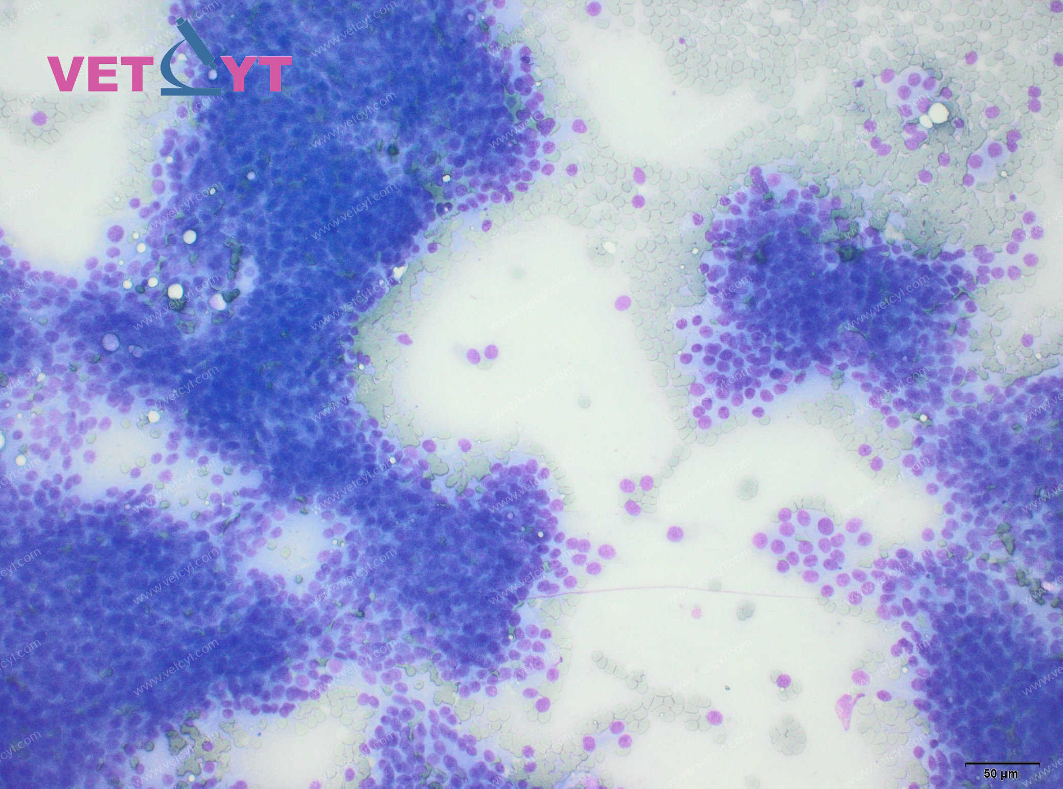 Adénocarcinome des glandes apocrines (marge anale)